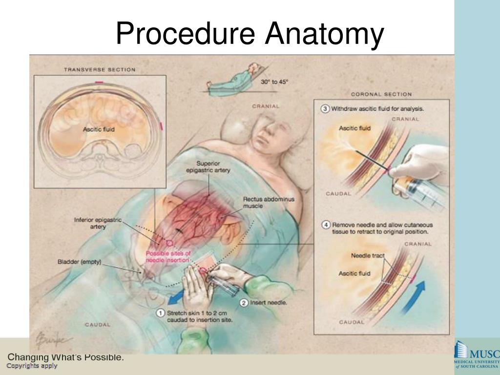 PPT - Paracentesis PowerPoint Presentation, free download - ID:6590134