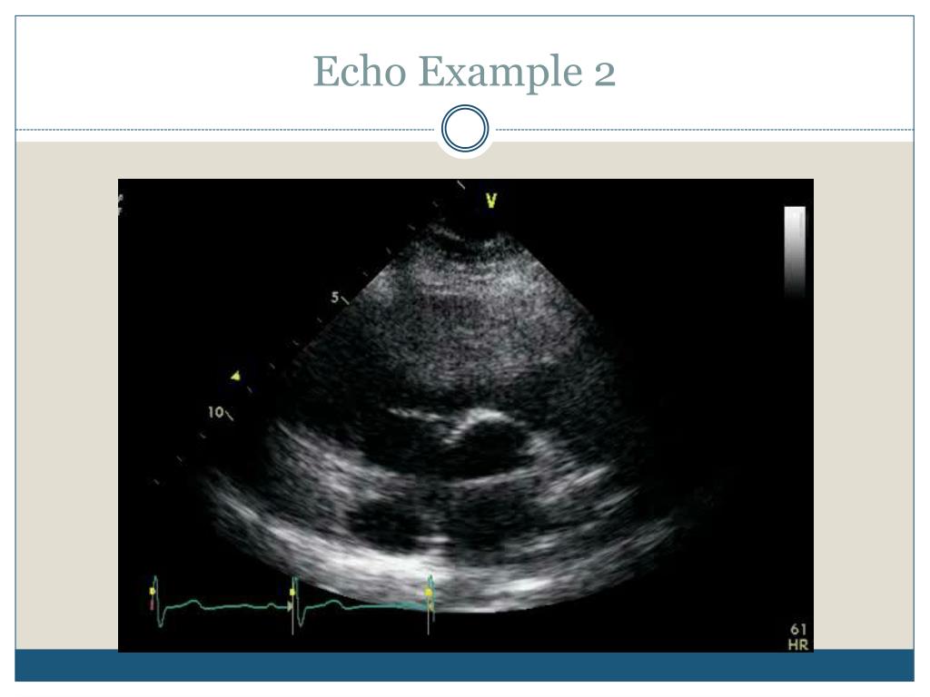 PPT Ventricular Septal Defects PowerPoint Presentation, free download