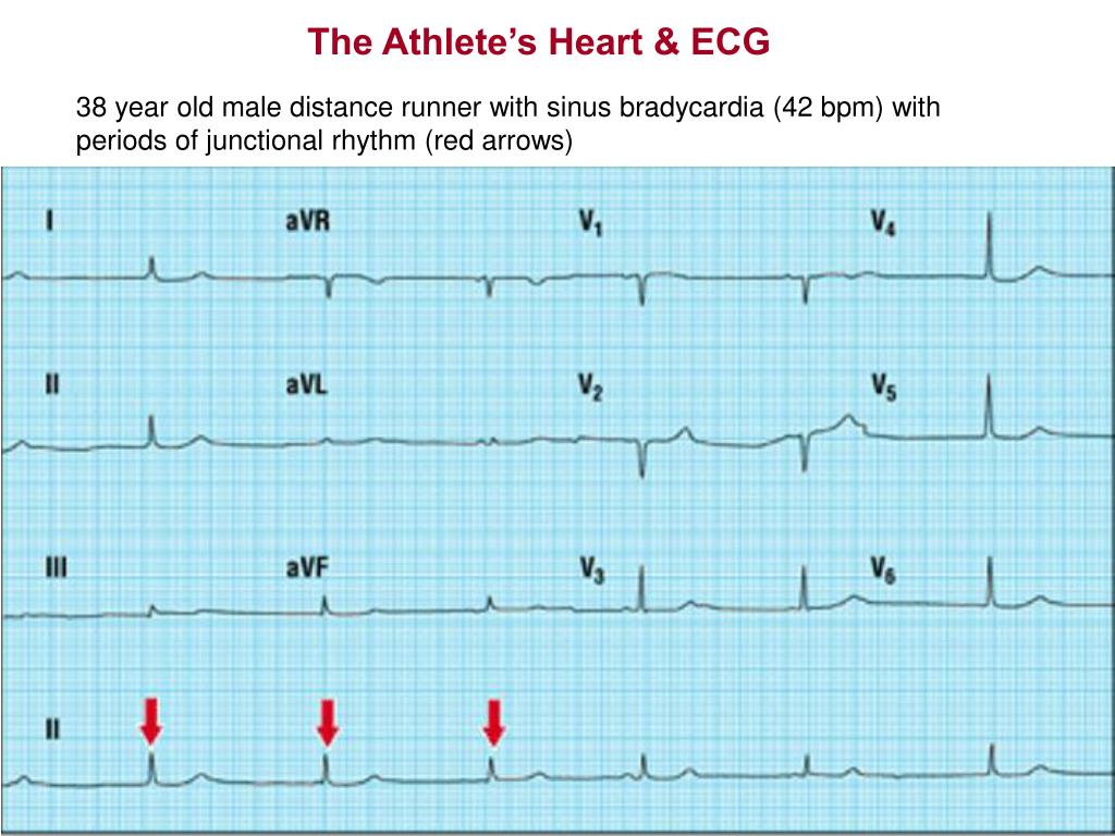 PPT KINE 639 Dr. Green Section 6 The Athlete’s Heart & ECG Reading