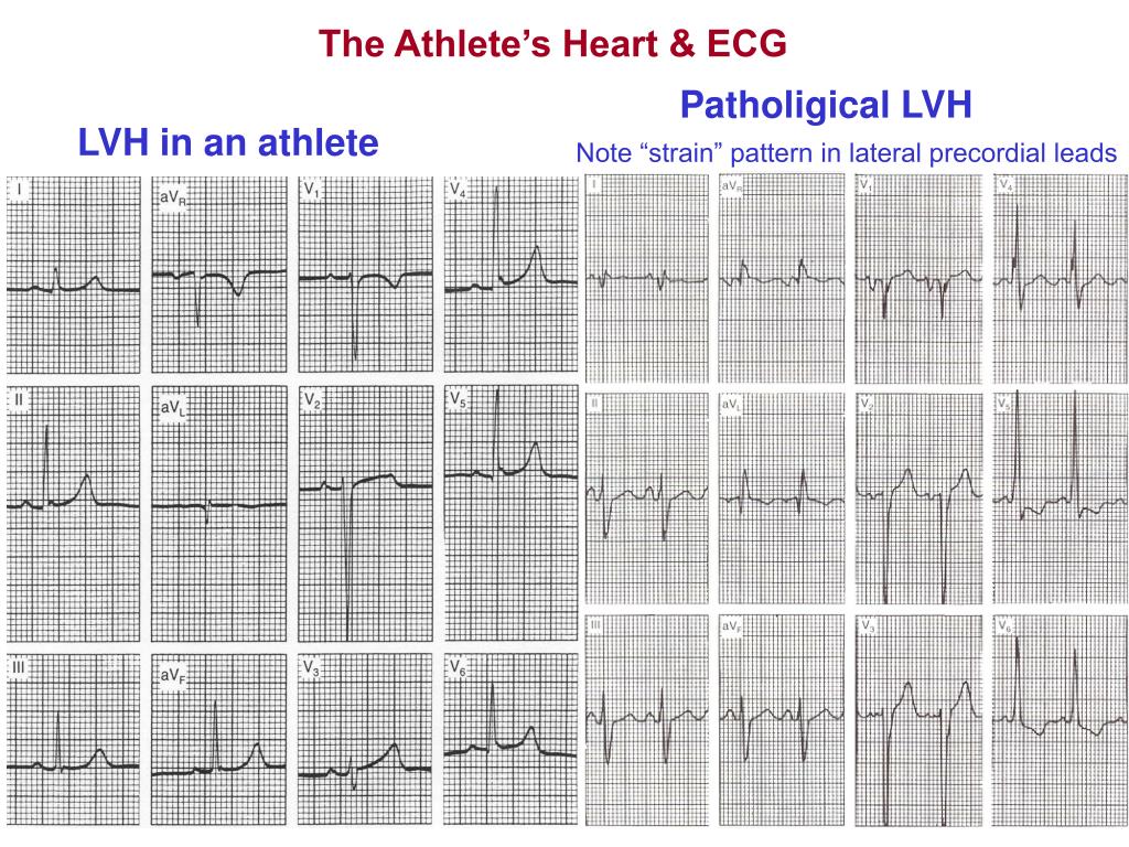 PPT KINE 639 Dr. Green Section 6 The Athlete’s Heart & ECG Reading