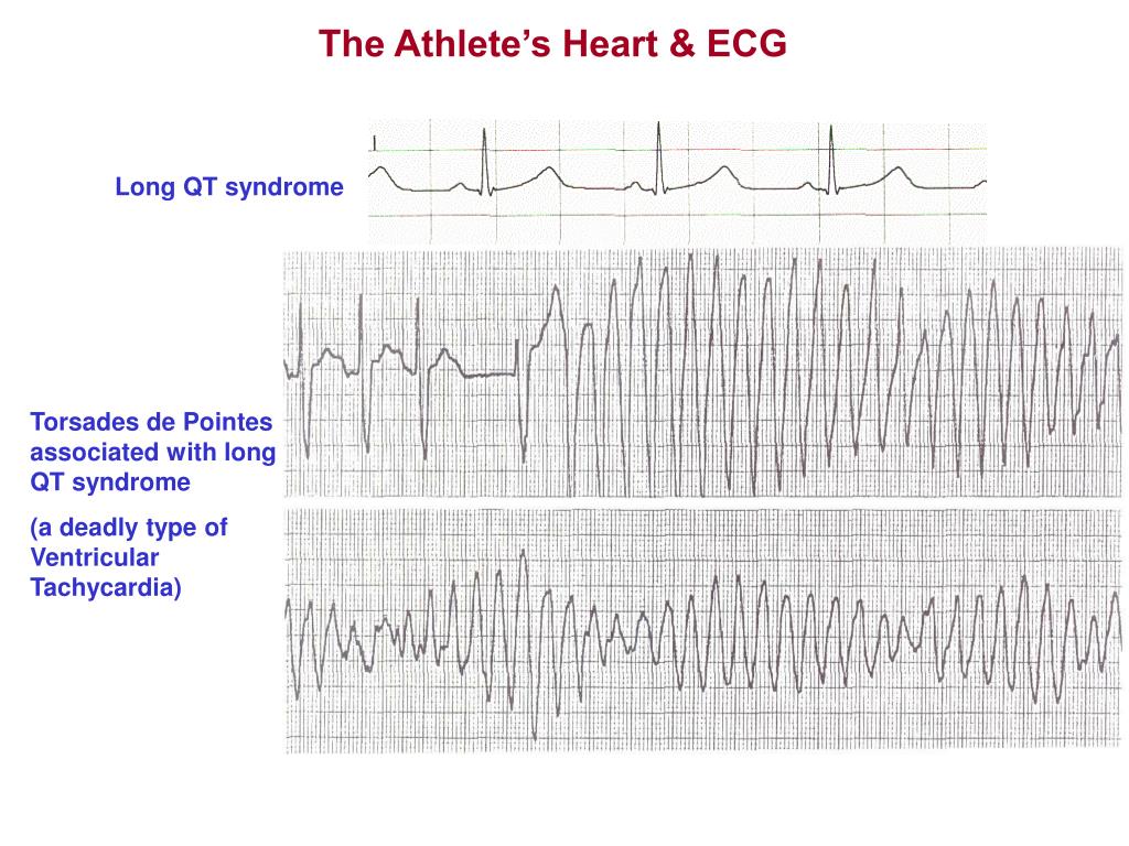 PPT KINE 639 Dr. Green Section 6 The Athlete’s Heart & ECG Reading