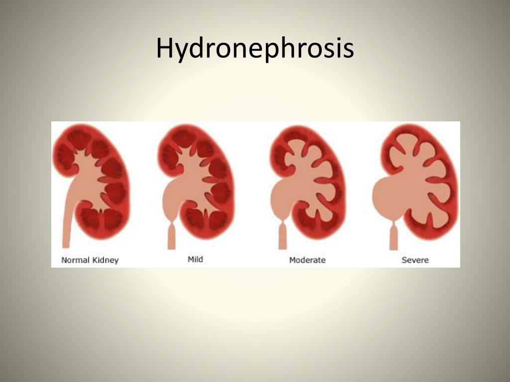 PPT APNEC Care of the Sick and Prematurely Born October 21, 2009 Renal & Genitourinary