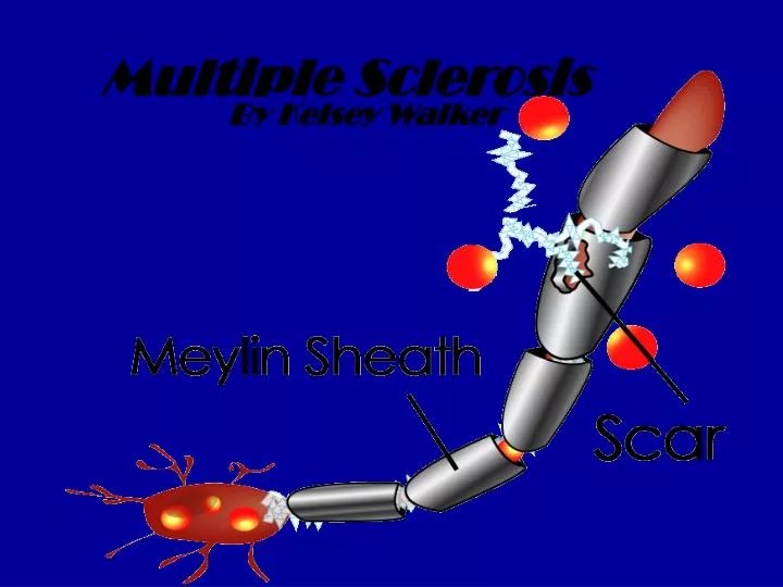 PPT Multiple Sclerosis PowerPoint Presentation ID6597393