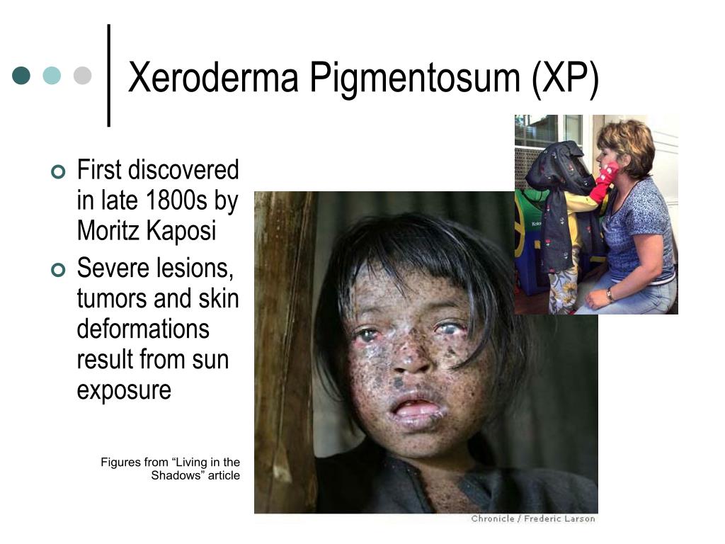 PPT Xeroderma Pigmentosum, XPF and Nucleotide Excision Repair