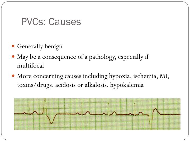 PPT Cardiac Arrhythmias PowerPoint Presentation ID6607564