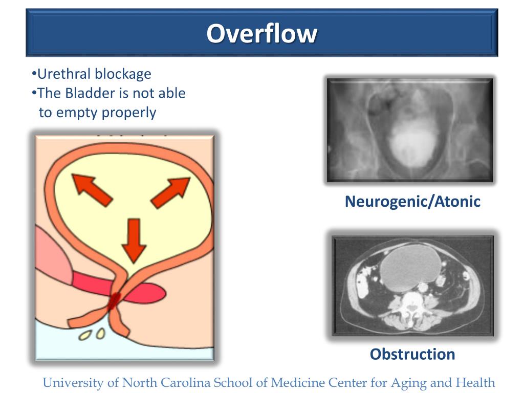 PPT Urinary Incontinence PowerPoint Presentation, free download ID