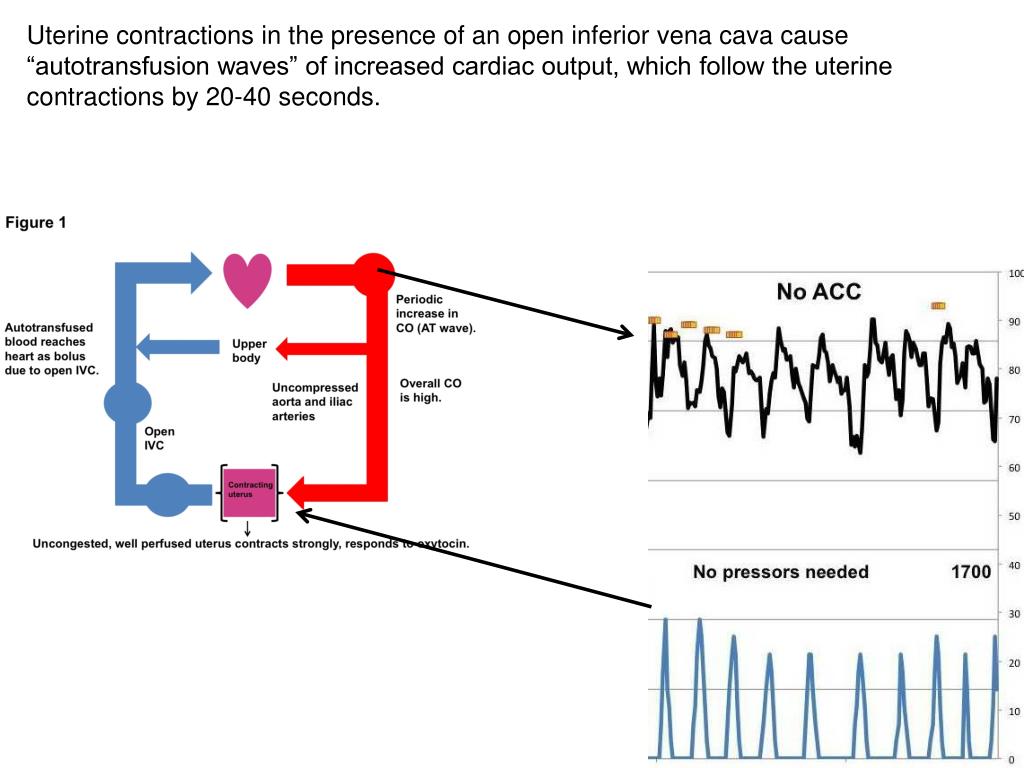 PPT Electrical Cardiometry for the measurement of cardiac output in