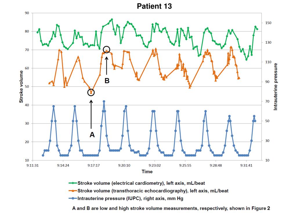 PPT Electrical Cardiometry for the measurement of cardiac output in