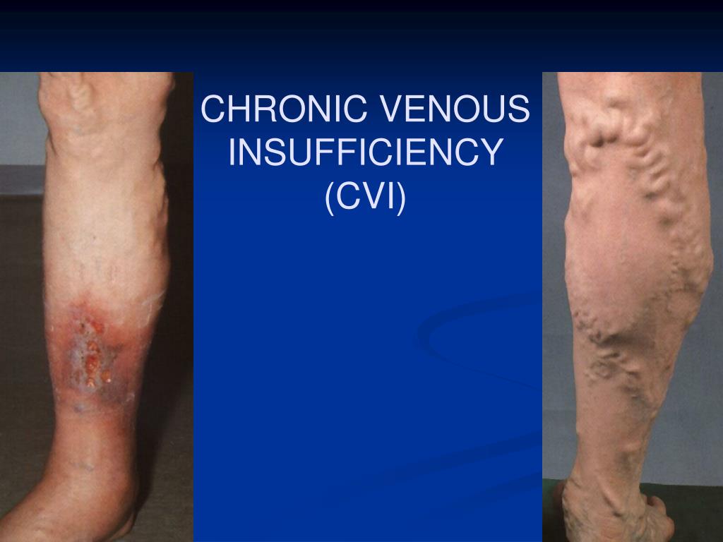 PPT CHRONIC VENOUS INSUFFICIENCY (CVI) PowerPoint Presentation, free
