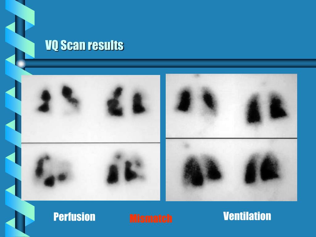 PPT EMORY FAMILY MEDICINE Differential Diagnosis of Chest Pain Susan