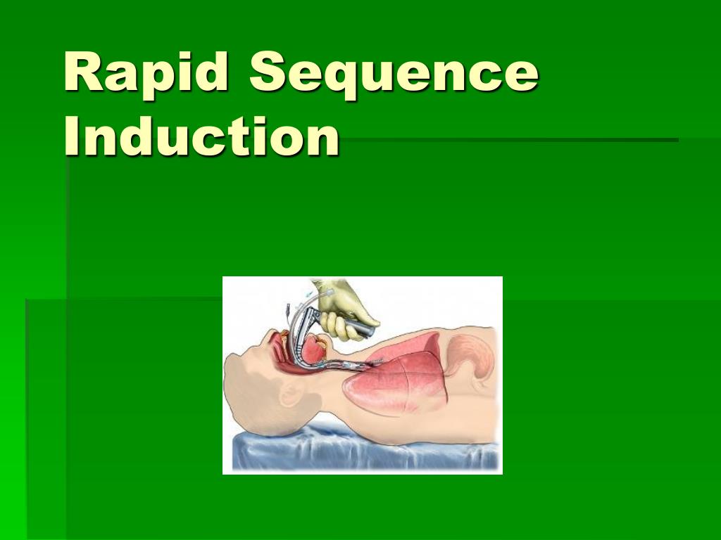 PPT Rapid Sequence Induction PowerPoint Presentation, free download