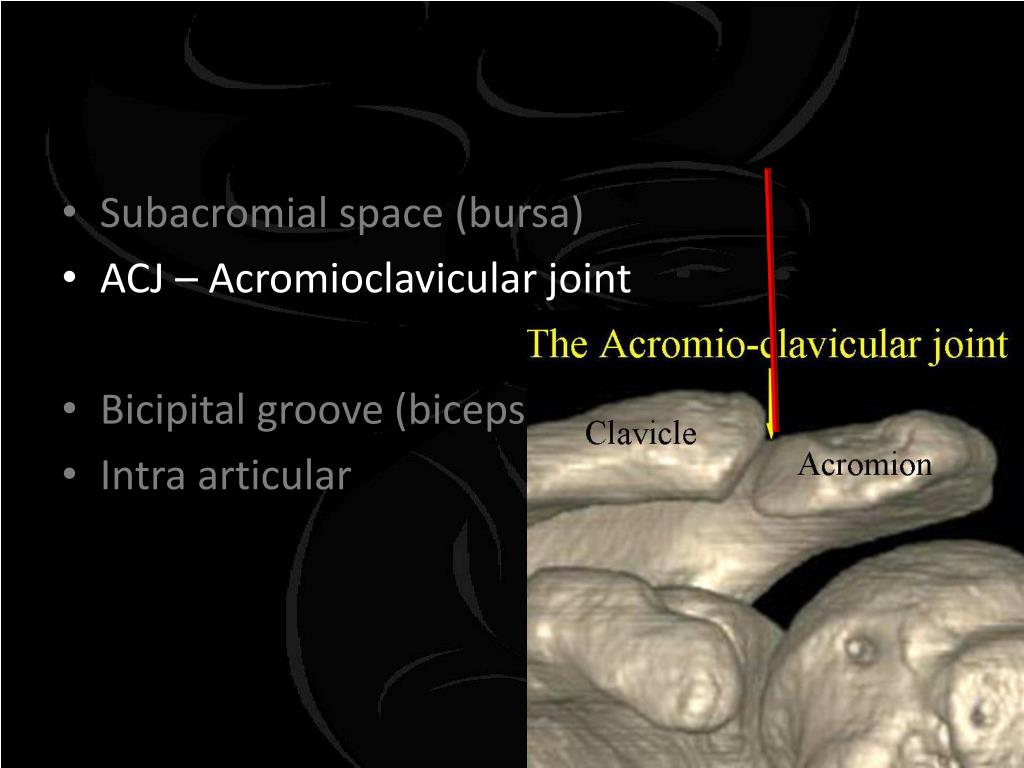 PPT Injections about the shoulder PowerPoint Presentation, free