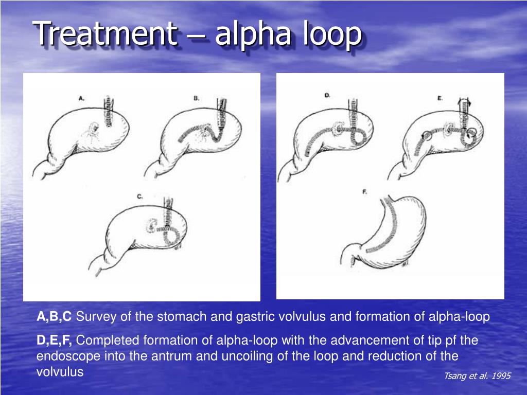 PPT Joint Hospital Grand Round Management of Chronic Gastric Volvulus