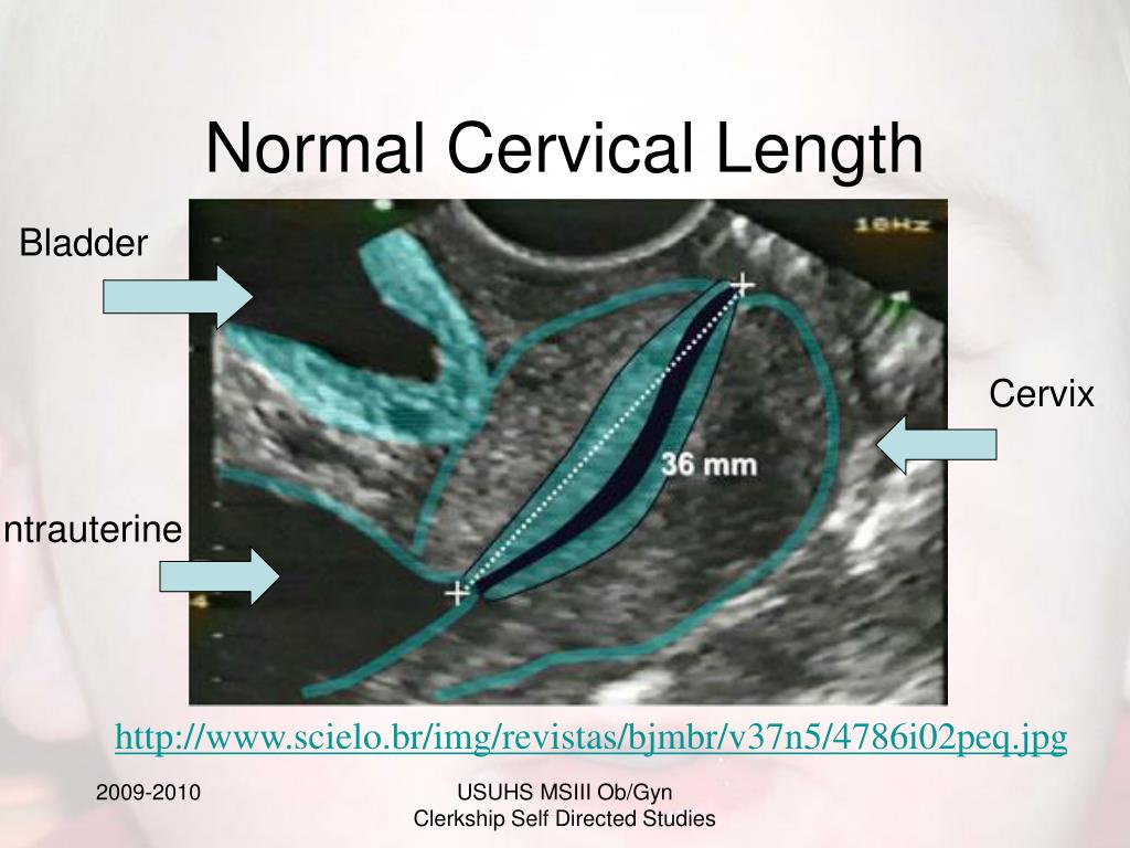 PPT Diagnostic Techniques for PreTerm Labor Ch 13 PowerPoint Presentation ID6739005