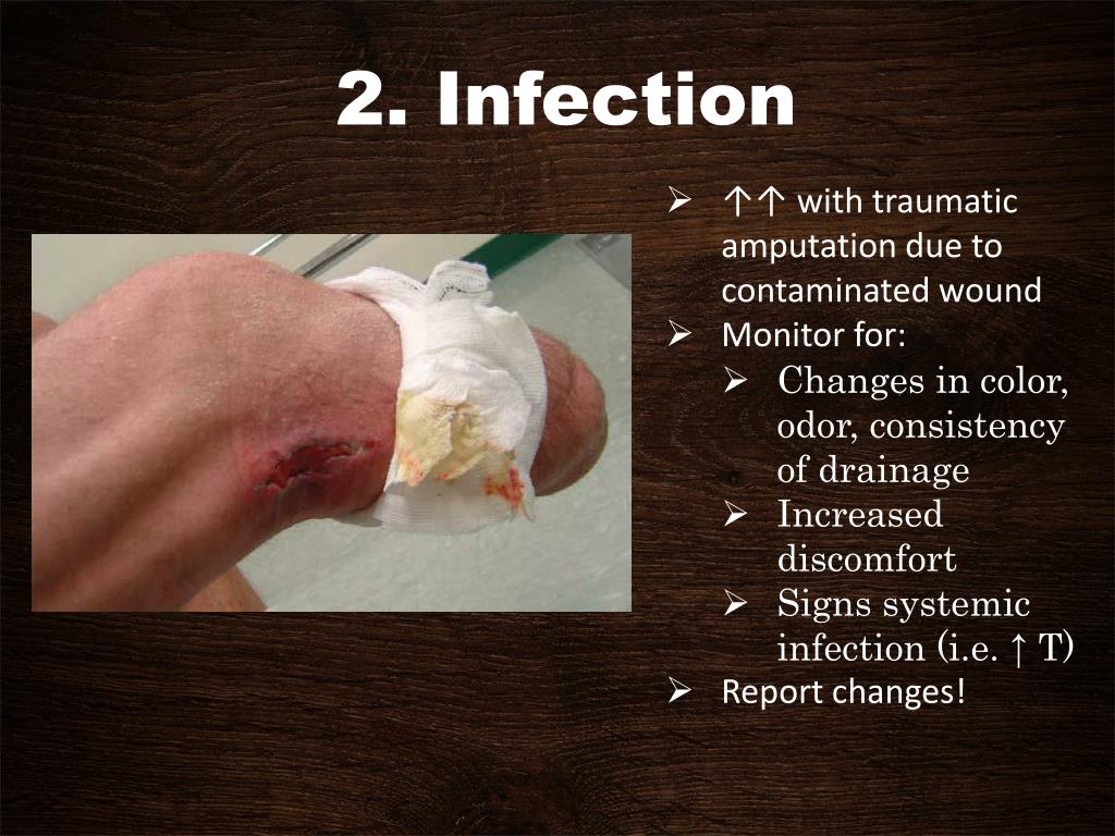 PPT AMPUTATIONS PowerPoint Presentation, free download ID6749099