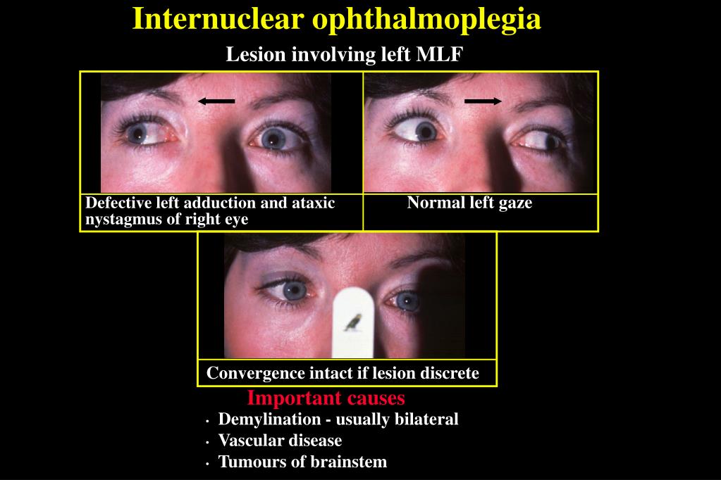 PPT SUPRANUCLEAR DISORDERS OF EYE MOVEMENT PowerPoint Presentation