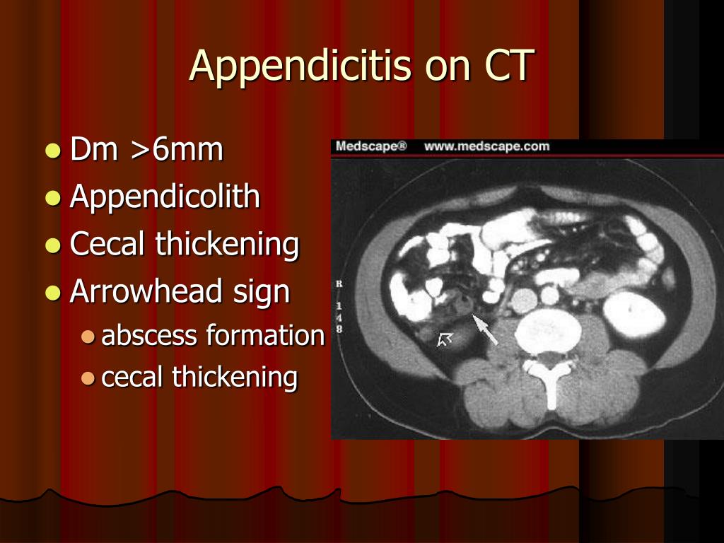 PPT Appendicitis PowerPoint Presentation, free download ID6769039