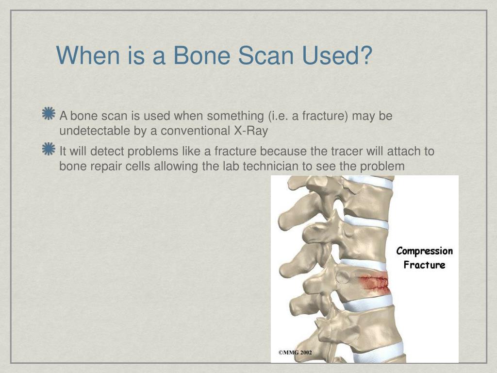 PPT The Bone Scan PowerPoint Presentation, free download