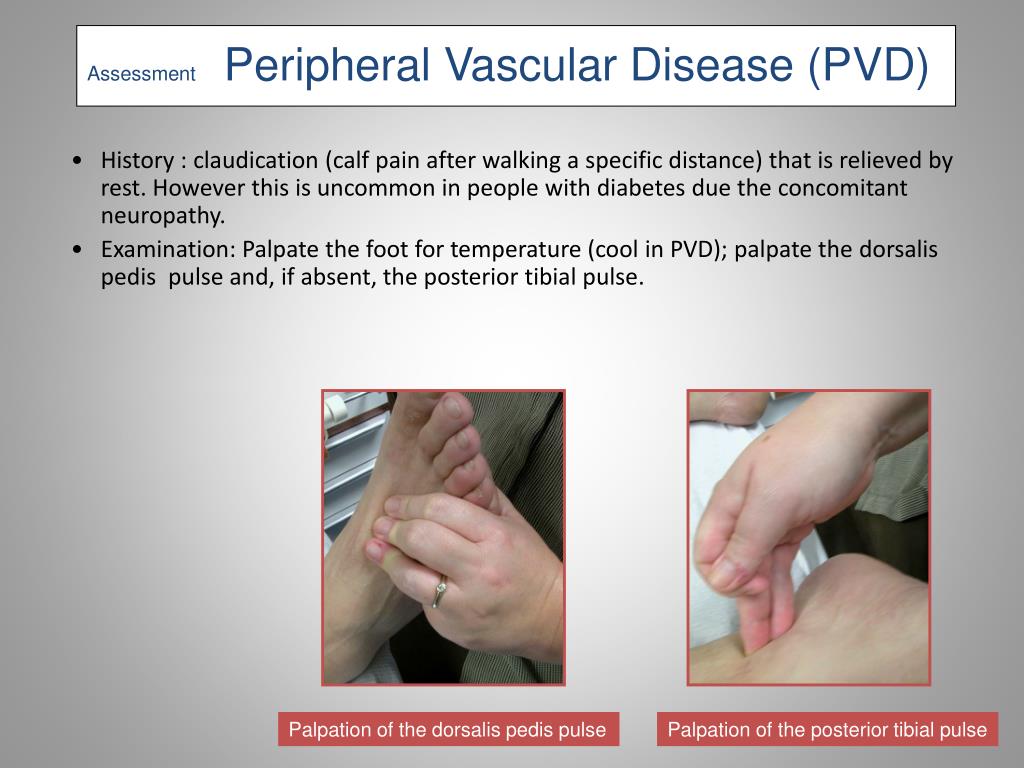 PPT Diabetic Foot PowerPoint Presentation, free download ID6819806