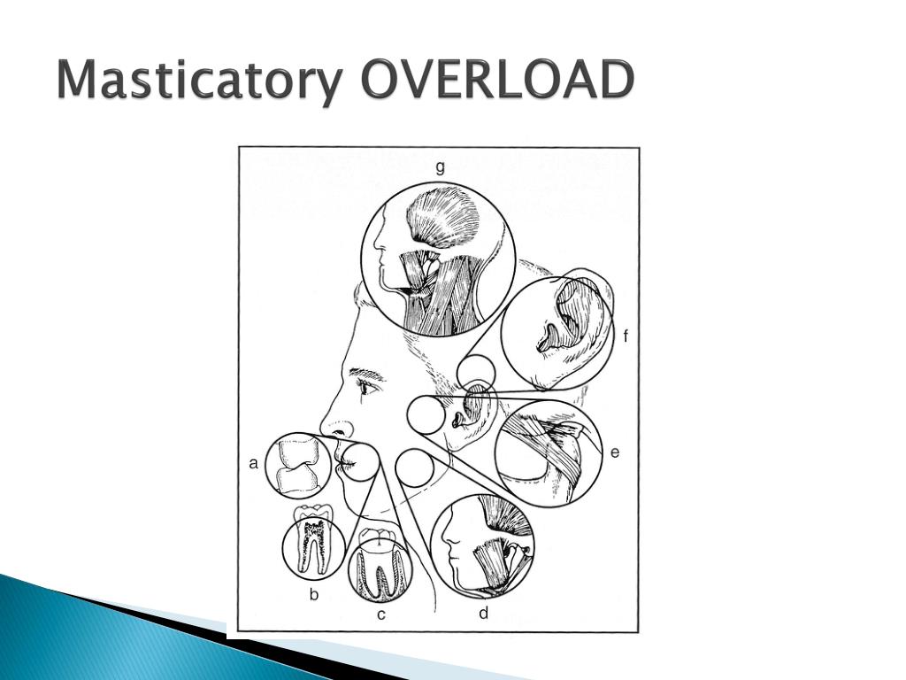 PPT MASTICATORY MUSCLE PAIN THEORY PowerPoint Presentation, free