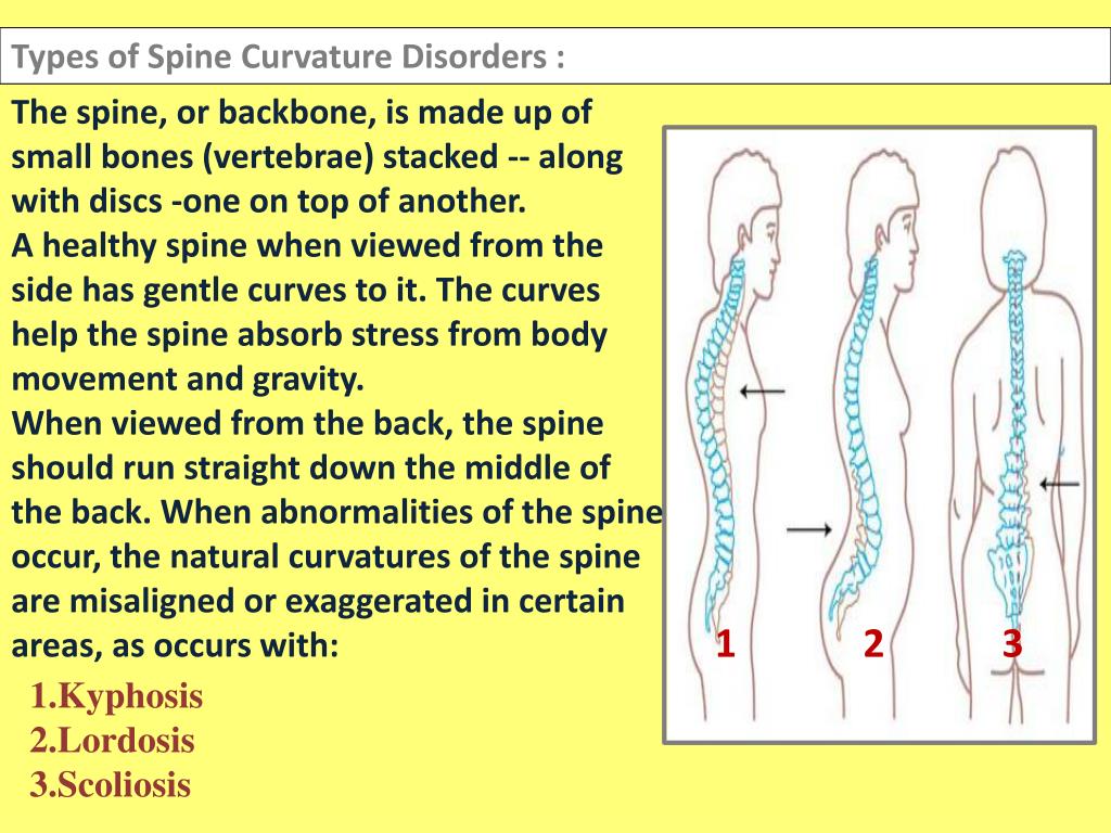 PPT Spine Curvature Disorders PowerPoint Presentation, free download
