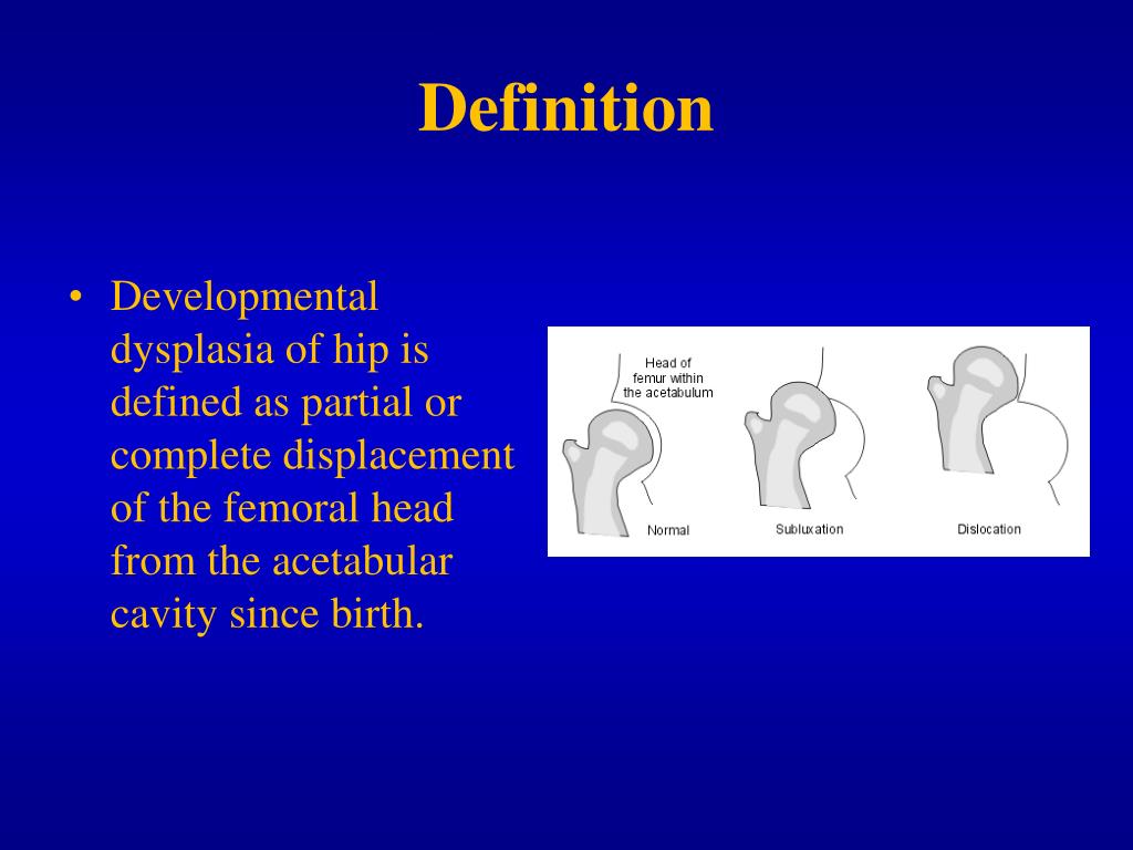 PPT Develompmental Dysplasia of the Hip (DDH) . As. Prof. Igor