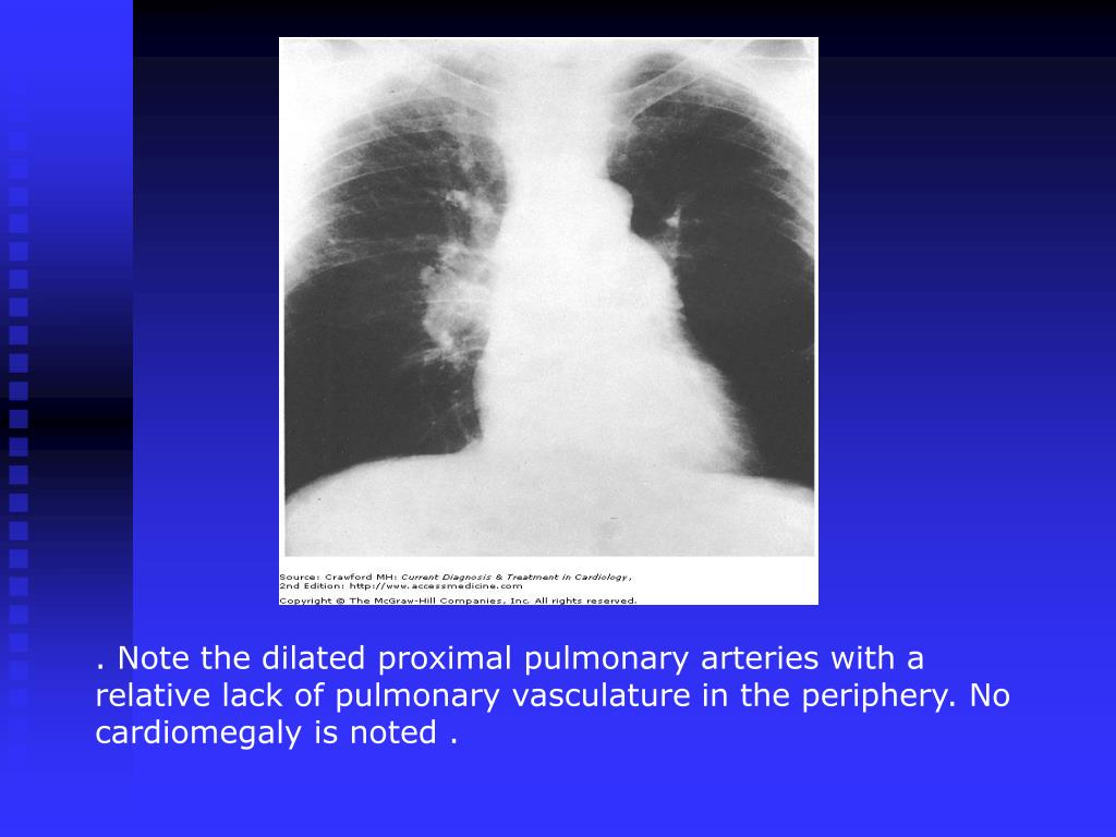 PPT Pulmonary Hypertension PowerPoint Presentation, free download