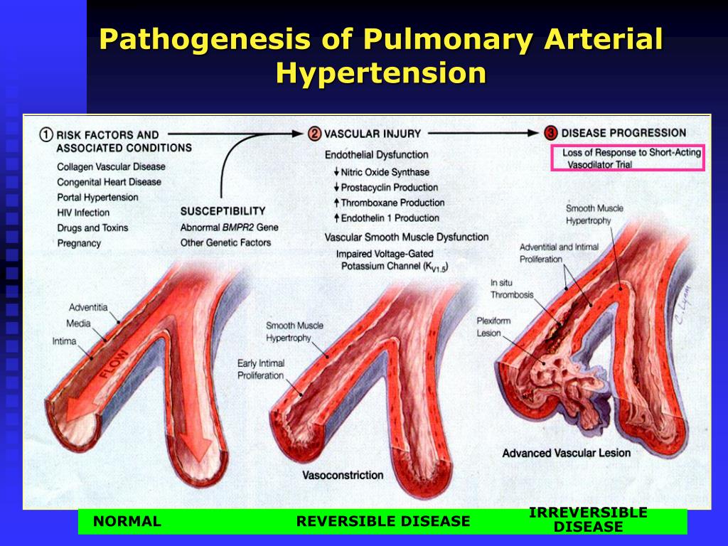 PPT Pulmonary Hypertension PowerPoint Presentation, free download