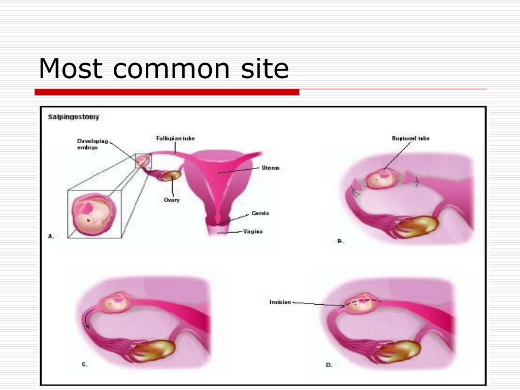 PPT Bleeding in Early Pregnancy PowerPoint Presentation, free