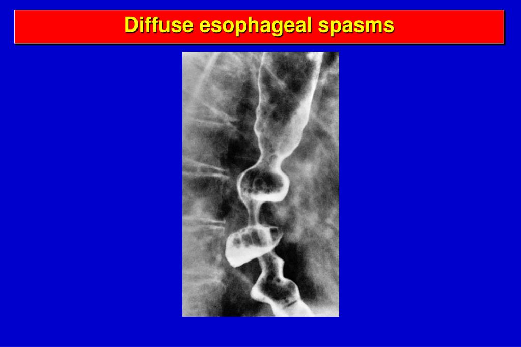 PPT DISEASES OF THE ESOPHAGUS PowerPoint Presentation, free download
