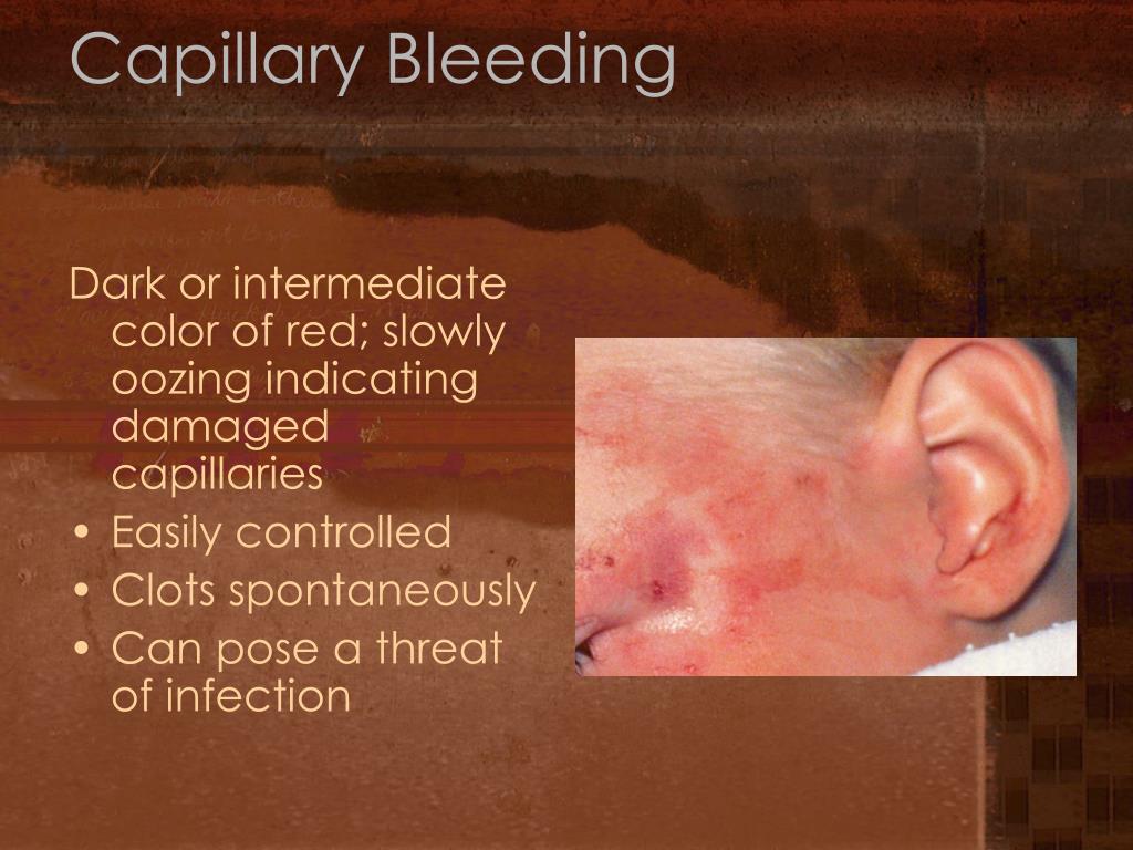 PPT Bleeding and Soft Tissue Trauma PowerPoint Presentation, free