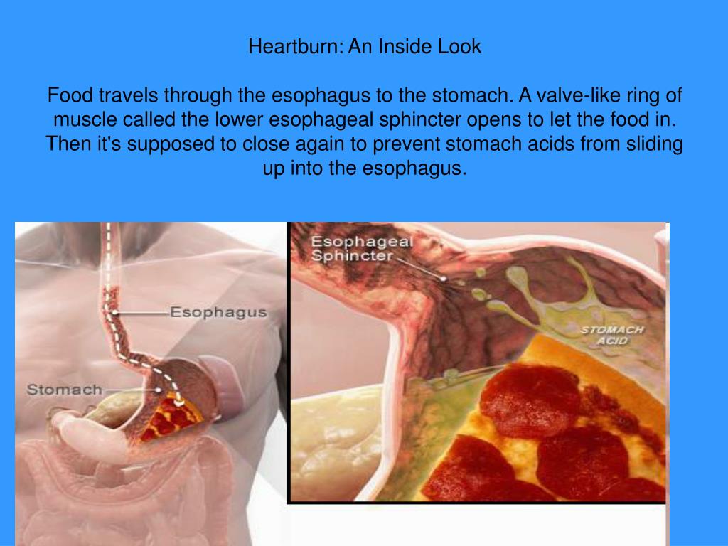 PPT HEARTBURN PowerPoint Presentation, free download ID6966072