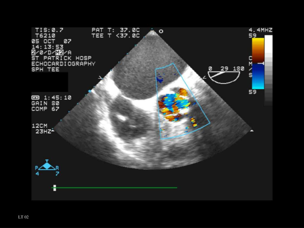 PPT Trileaflet Aortic Valve PowerPoint Presentation, free download