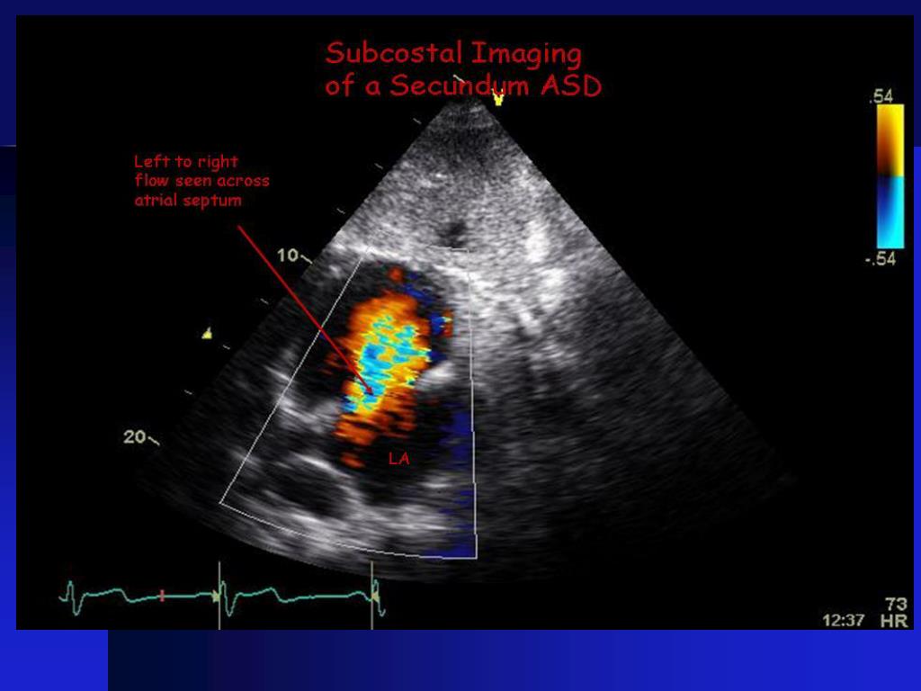 PPT Atrial Septal Defects PowerPoint Presentation, free download ID