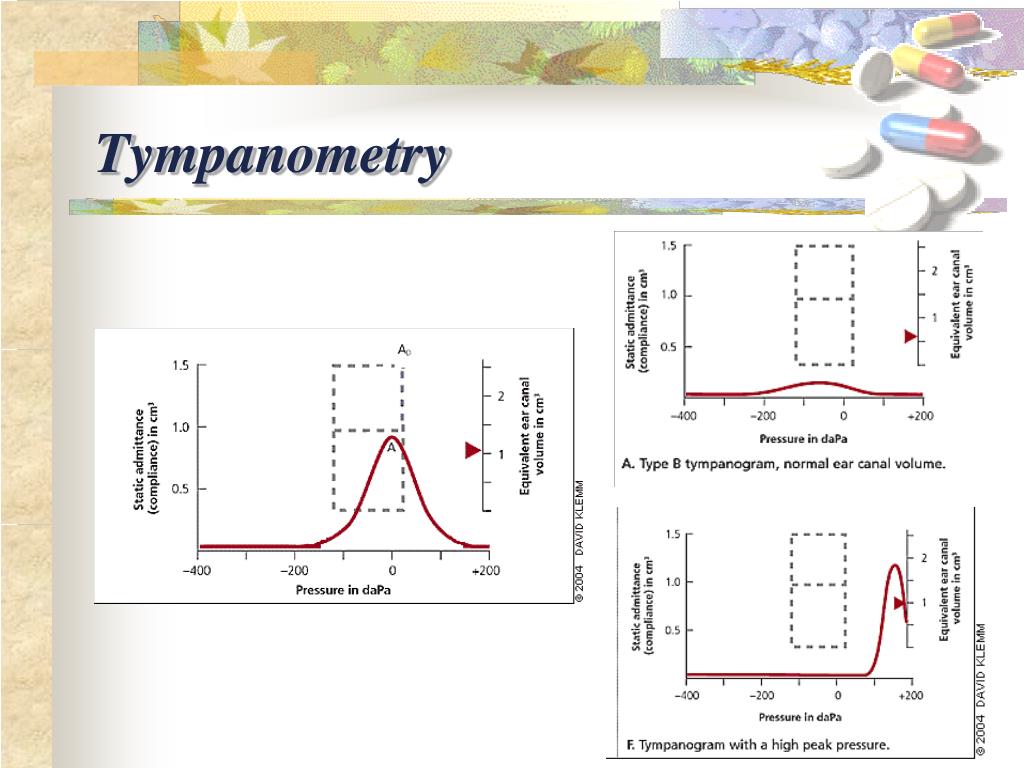 PPT Acute Otitis Media PowerPoint Presentation, free download ID