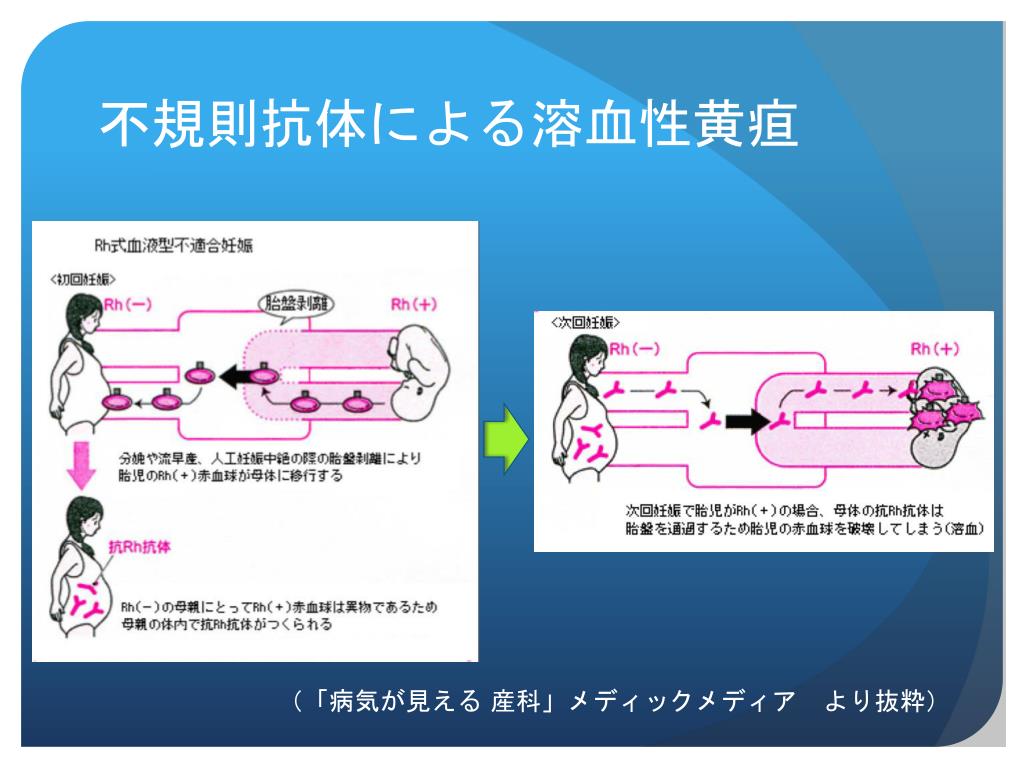 PPT 生後早期からの経皮黄疸計管理により発見された 抗 Mi a 抗体による新生児溶血性黄疸の 1 例