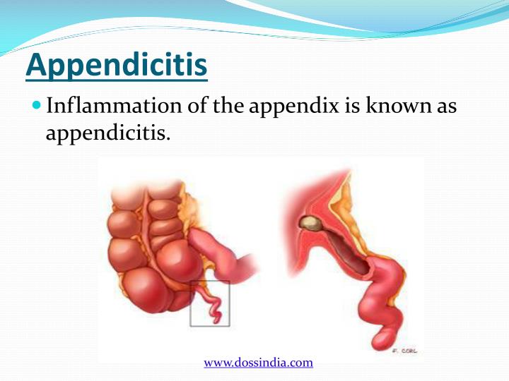 Ppt Doss India Appendix Surgery Treatment In Pune Maharashtr