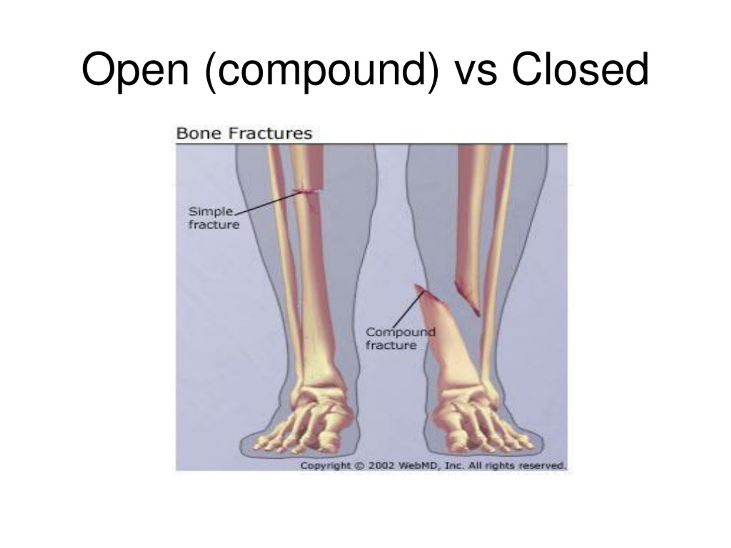 PPT Types of Fractures PowerPoint Presentation, free download ID262754