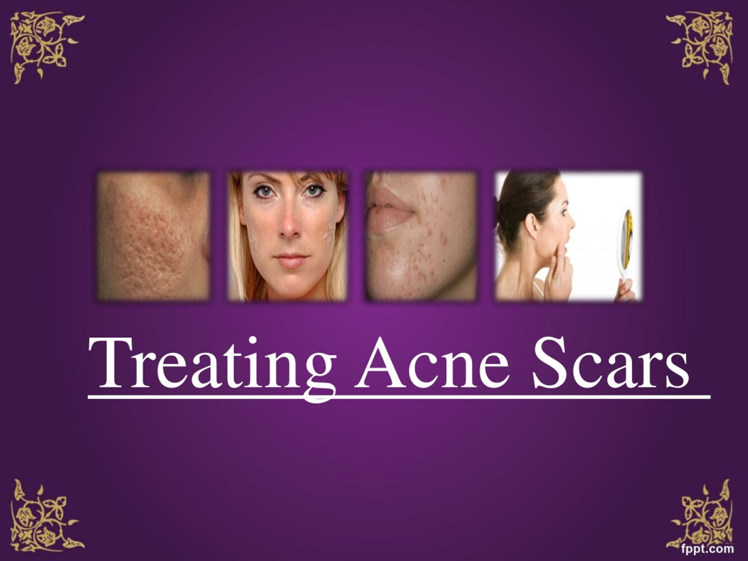 PPT Treating Acne Scars PowerPoint Presentation, free download ID