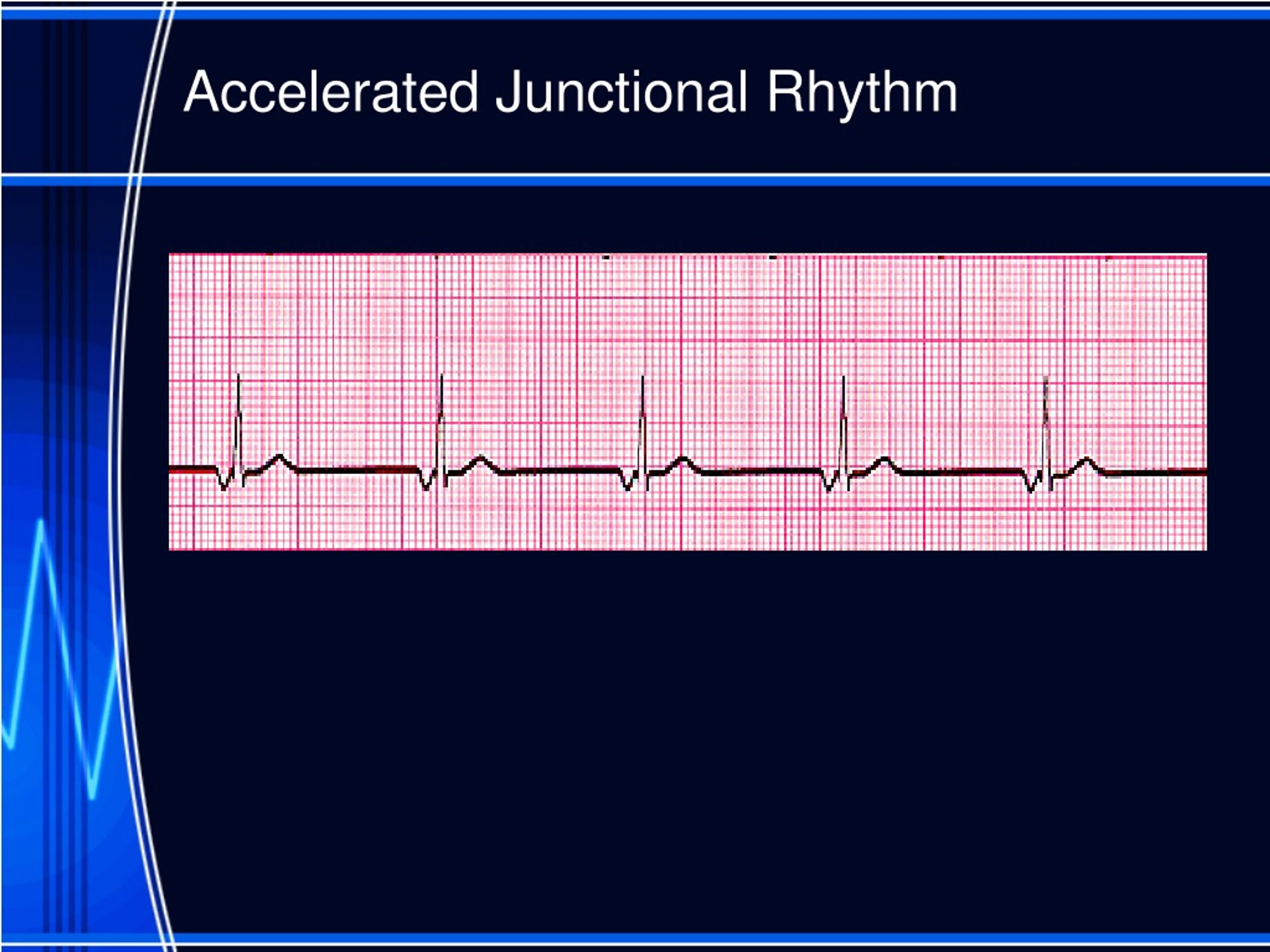 PPT Nursing Interpretation of the Electrocardiogram (ECG), Telemetry PowerPoint Presentation