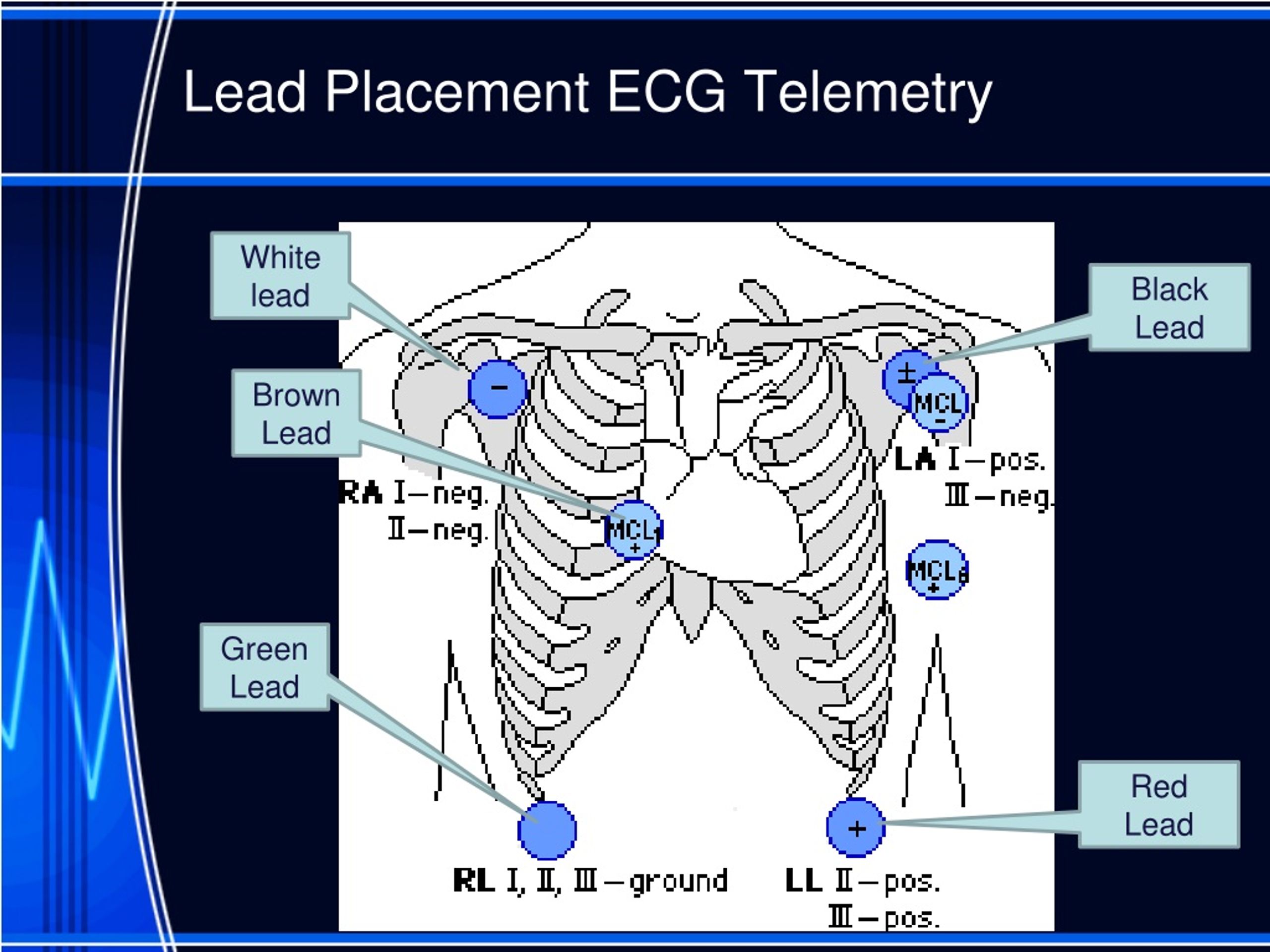PPT Nursing Interpretation of the Electrocardiogram (ECG), Telemetry