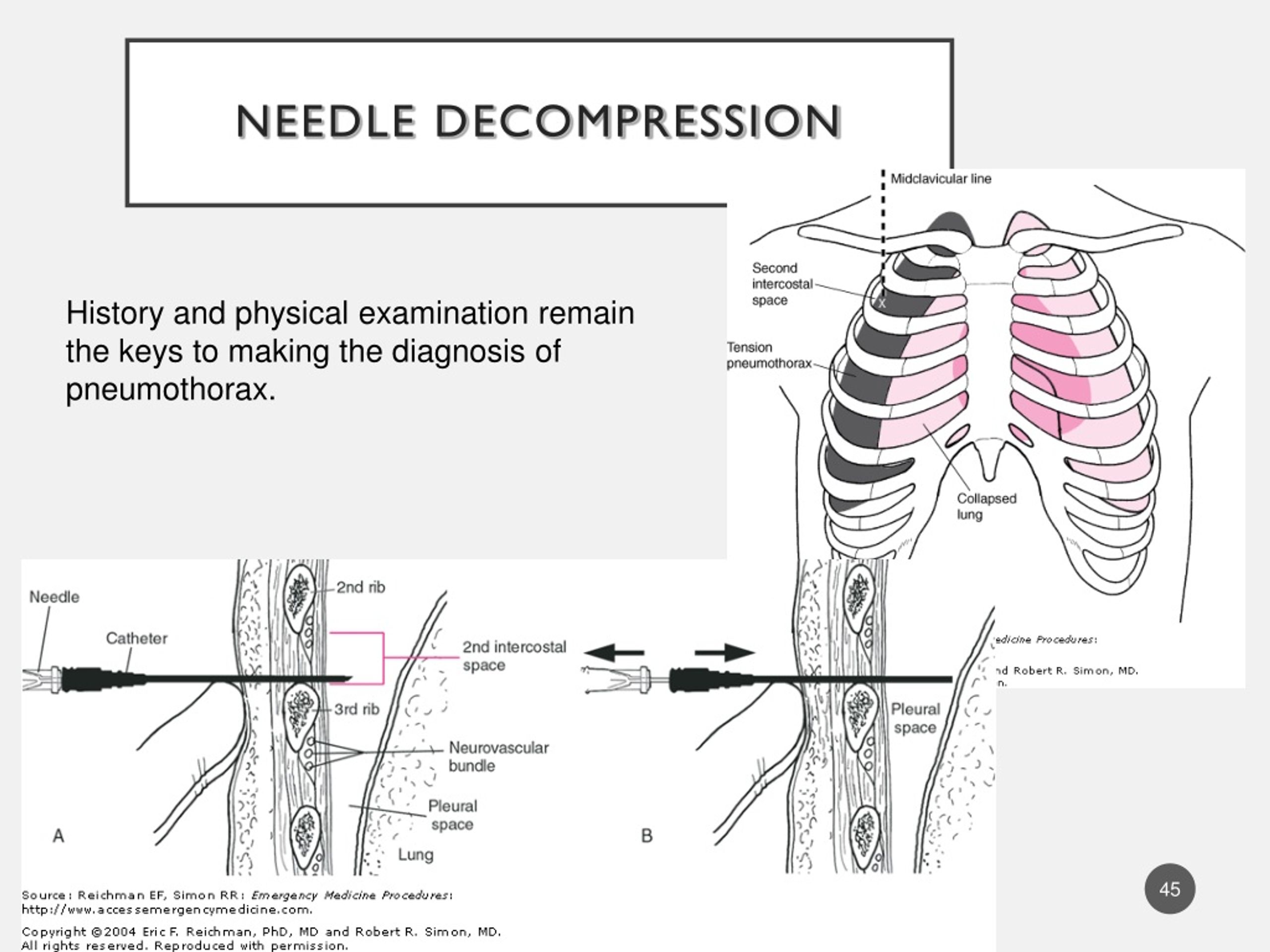 PPT Acute Chest Pain PowerPoint Presentation, free download ID459436
