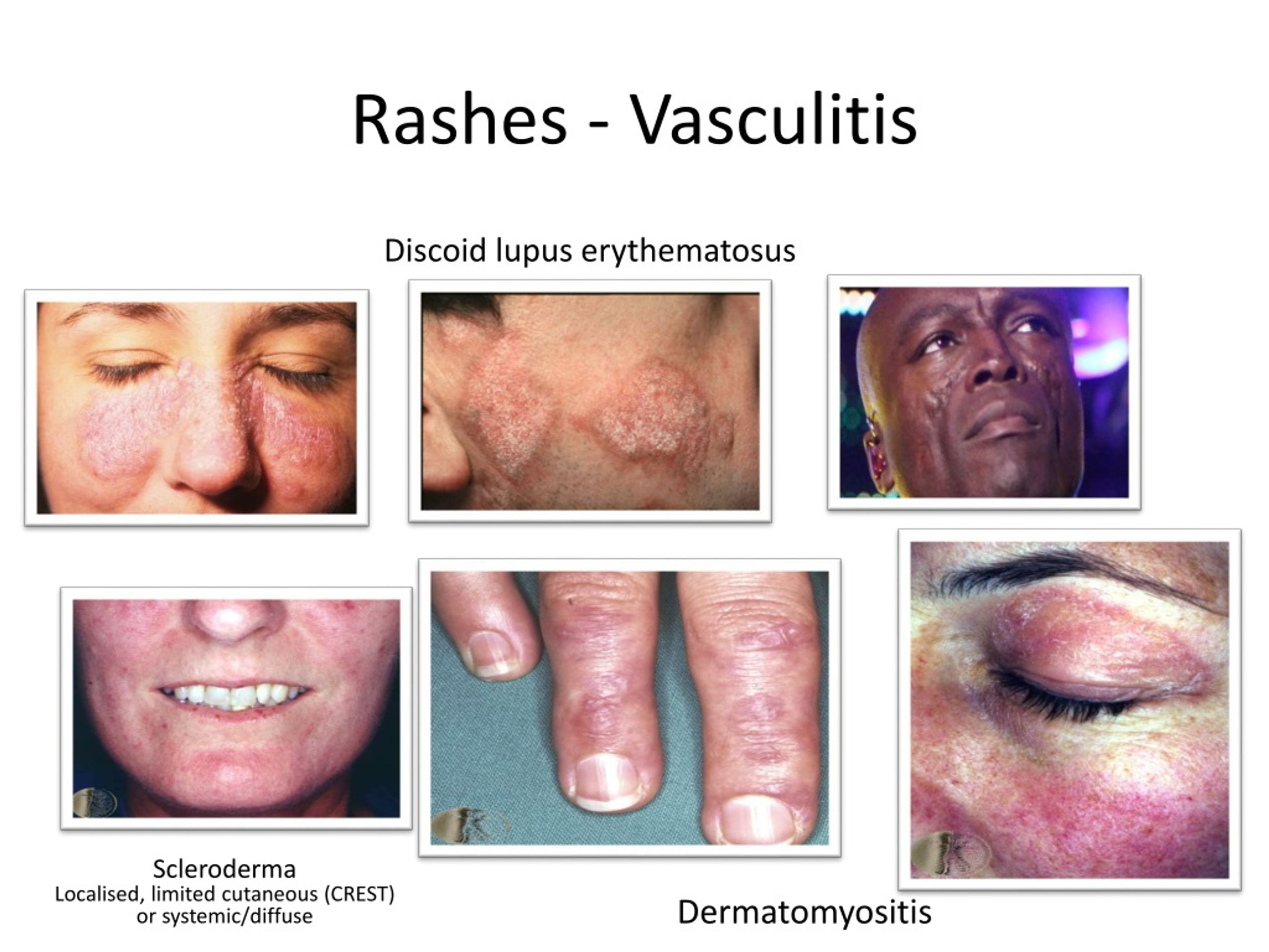 Allergic Vasculitis Rash
