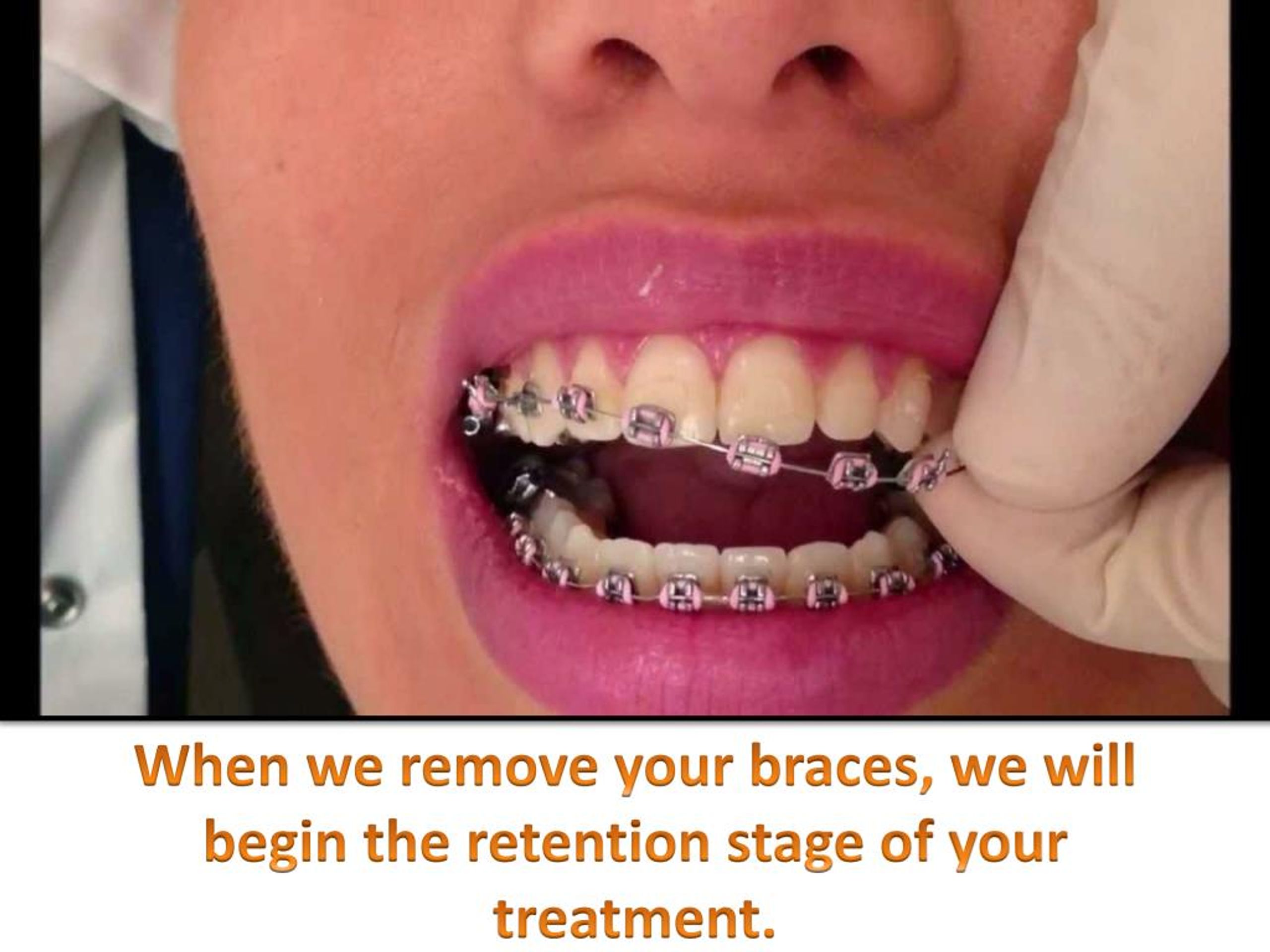 PPT Retention Dental Treatment in Texas At Hiremath Orthodontics
