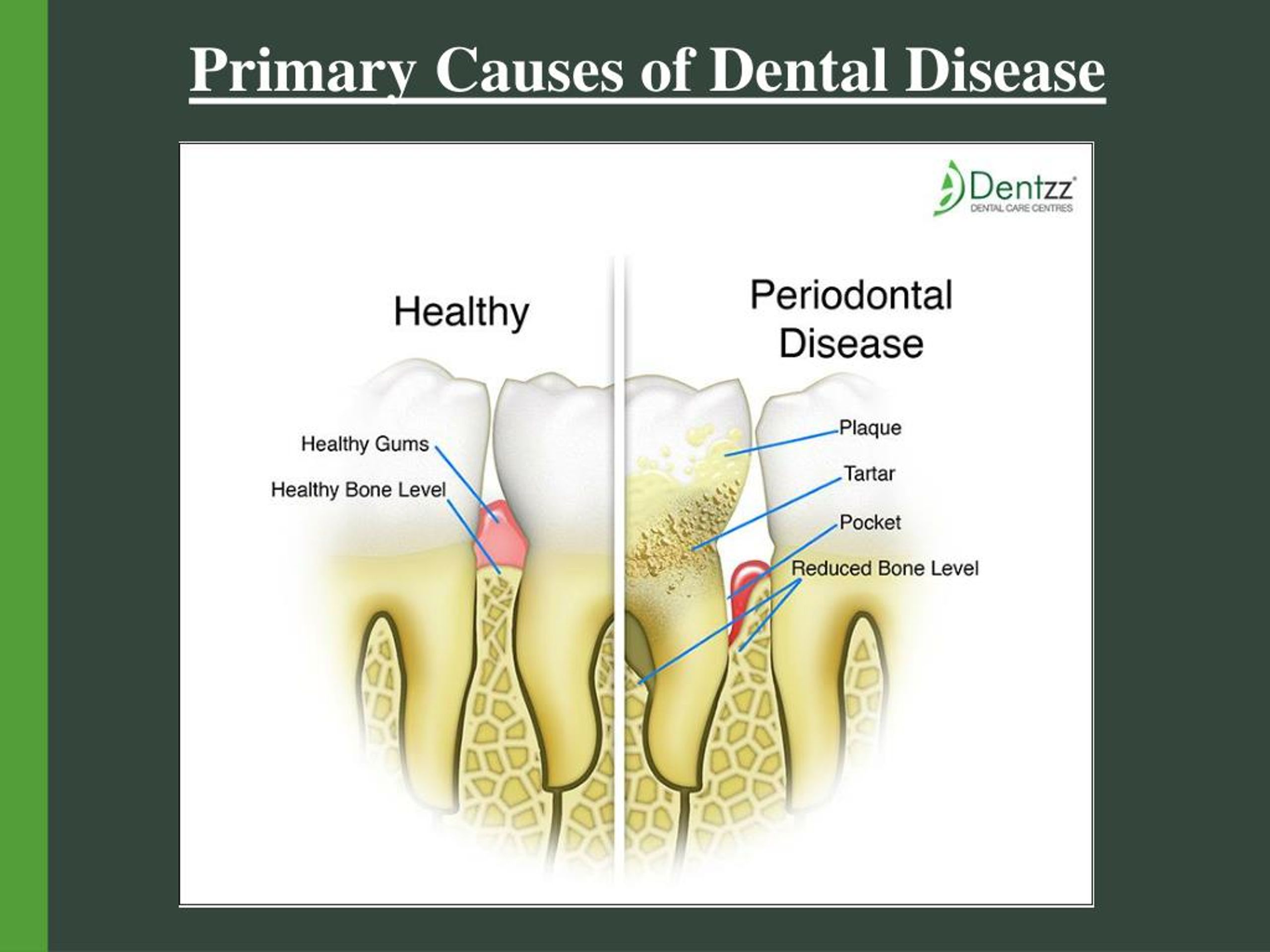 PPT Primary Causes of Dental Disease PowerPoint Presentation, free download ID7301166