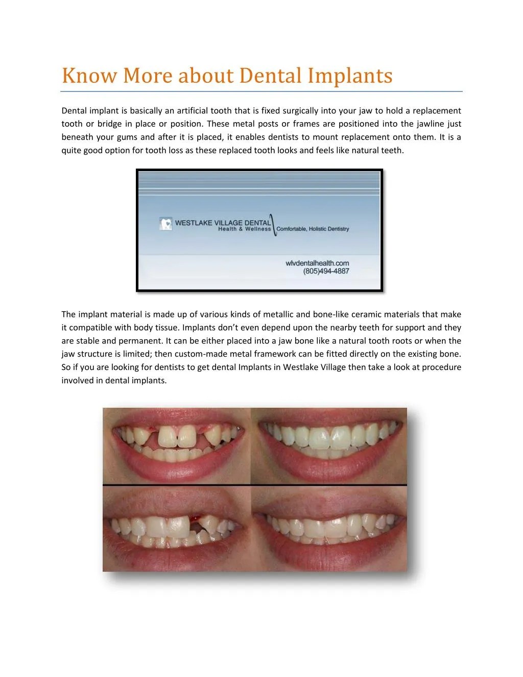 PPT Know More about Dental Implants PowerPoint Presentation, free