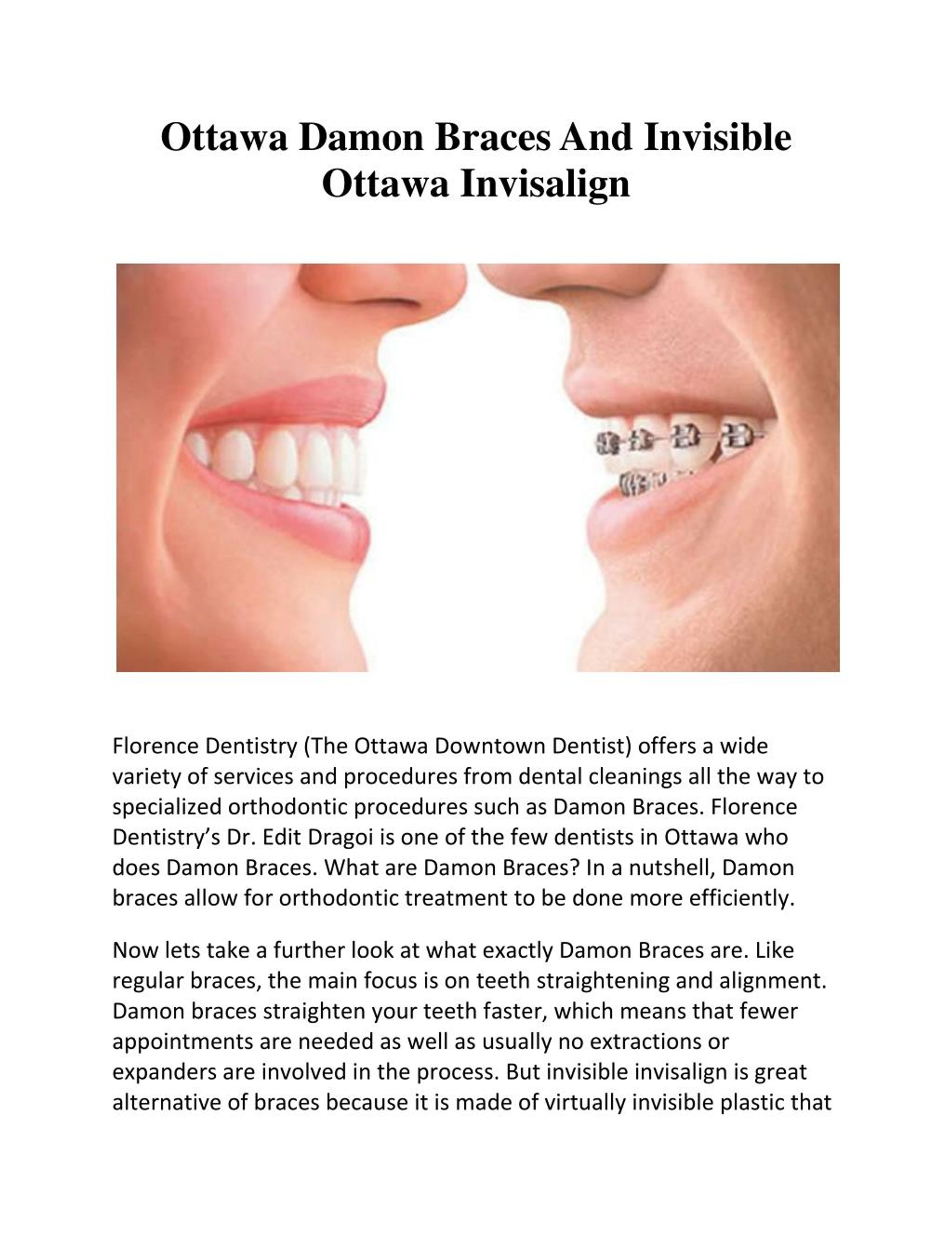 PPT Ottawa Damon Braces And Invisible Ottawa Invisalign PowerPoint