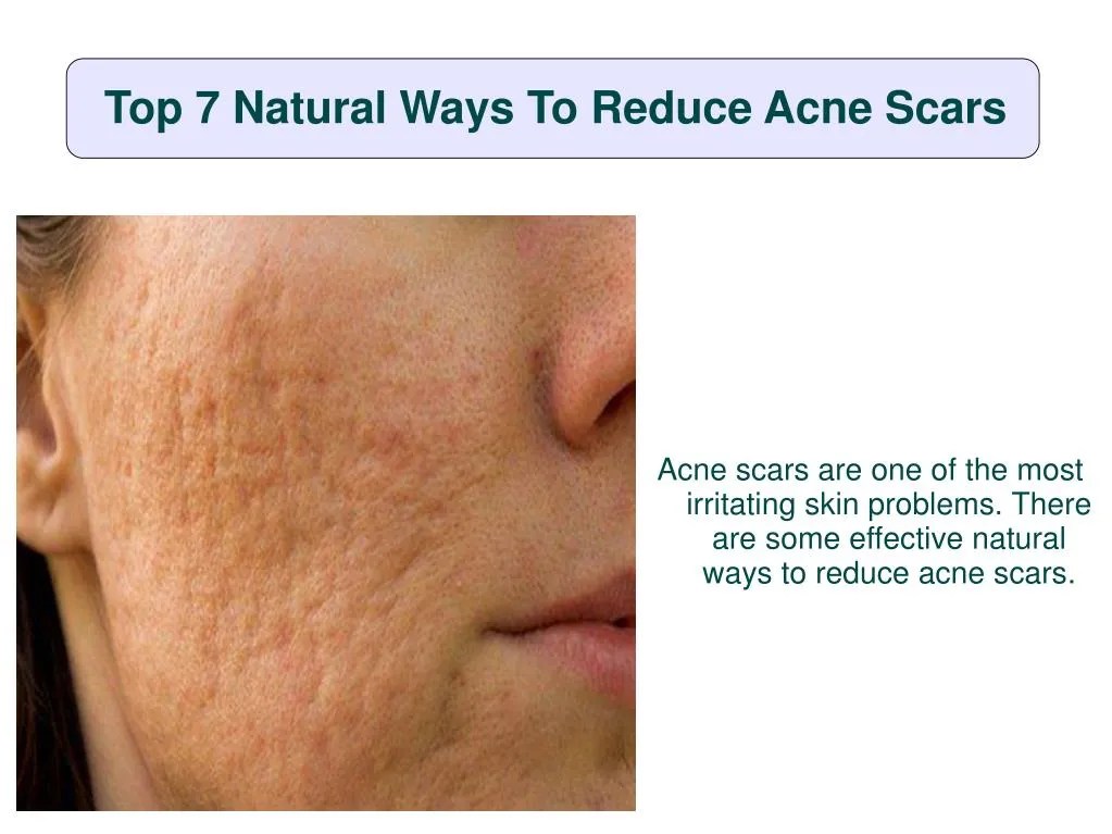 PPT Top 7 natural ways to reduce acne scars PowerPoint Presentation