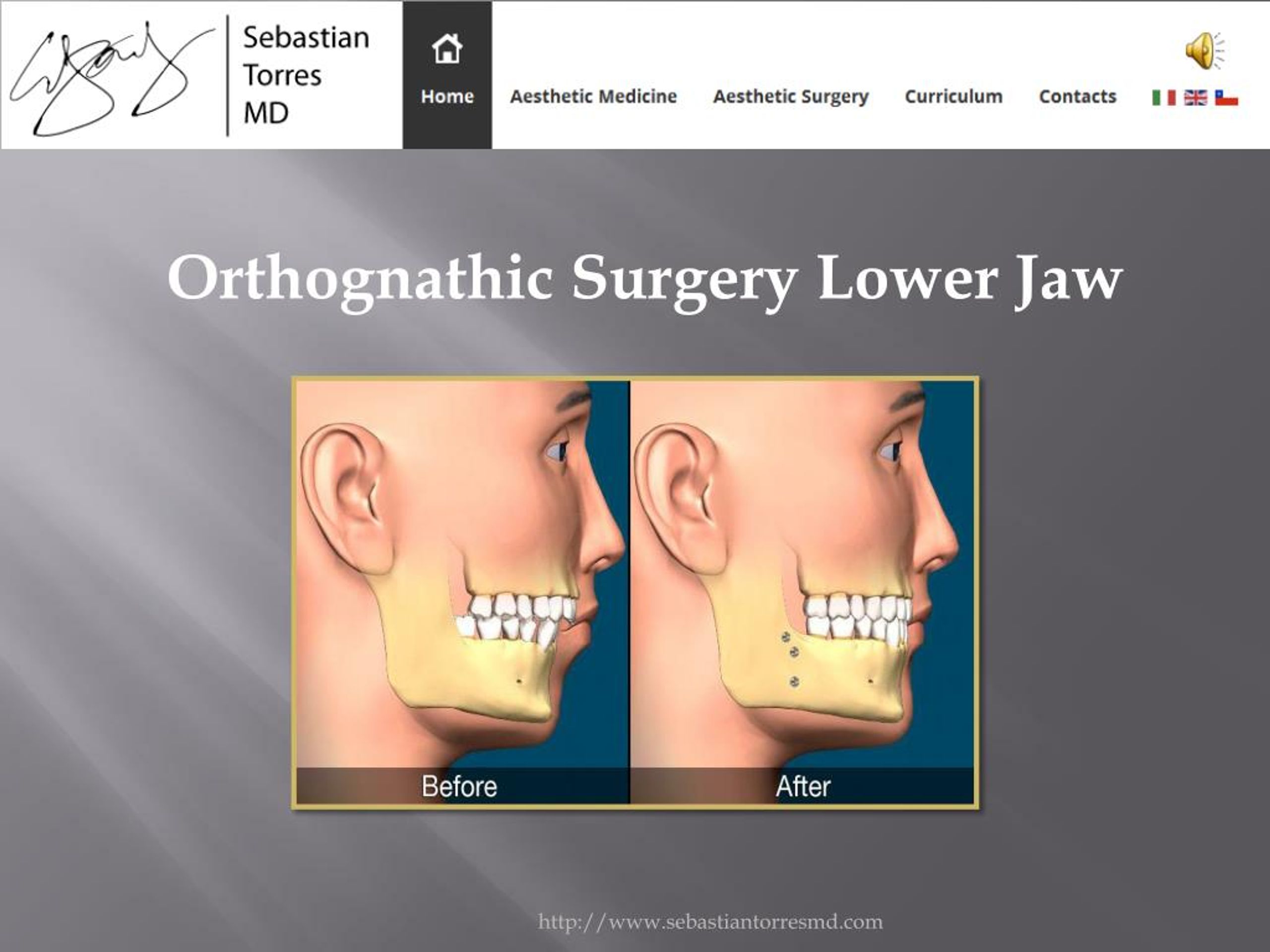 PPT Orthognathic Surgery Lower Jaw PowerPoint Presentation, free download ID7316121