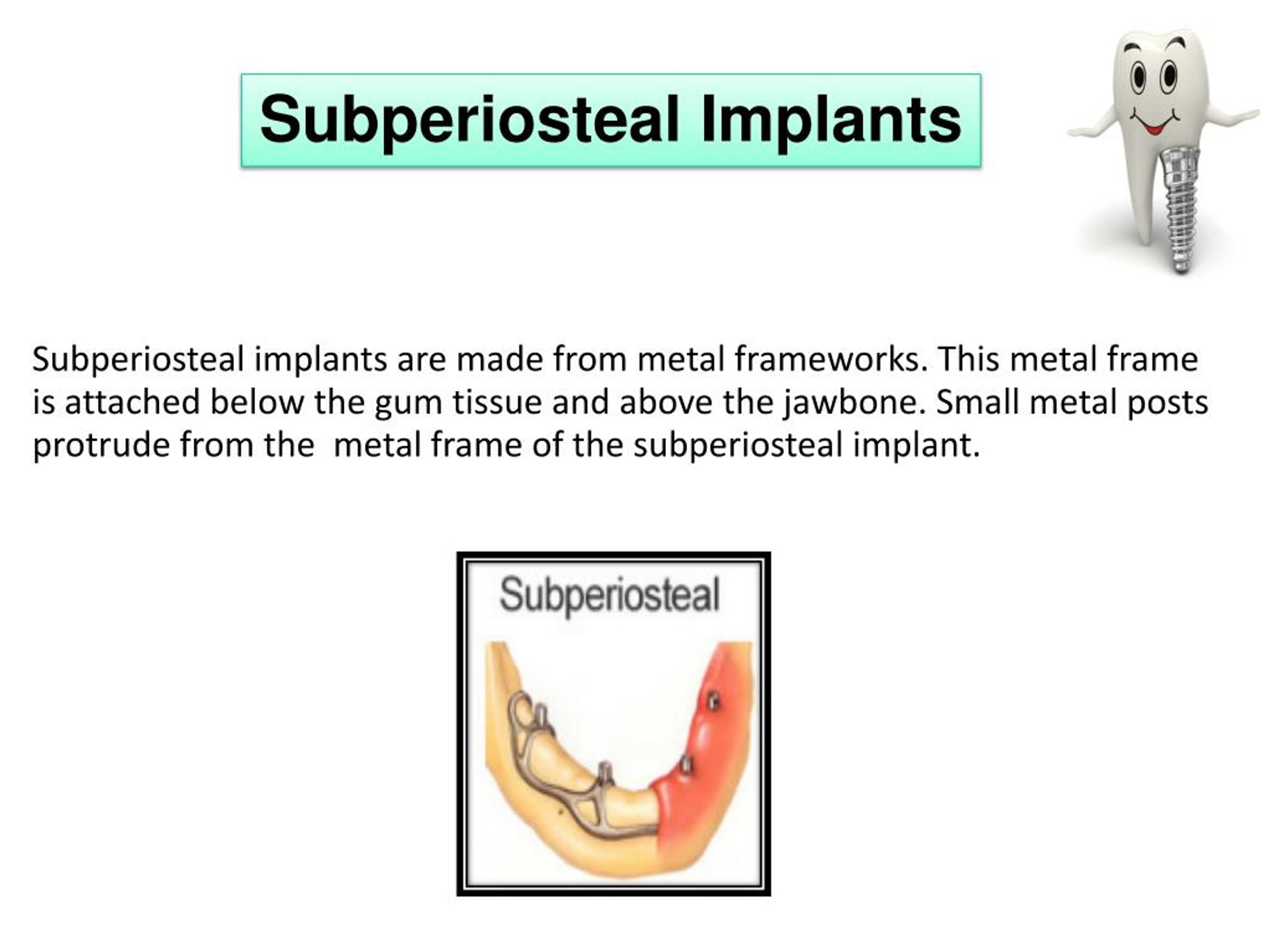 PPT Replace Missing Tooth With Dental Implants PowerPoint